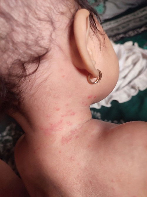 bintik" merah berisi air