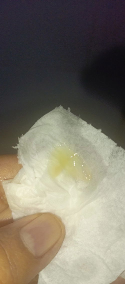 Keputihan kekuningan sedikit coklat  tanpa gatal