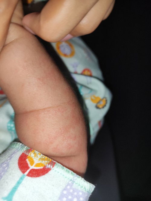 Bintik bercak putih merah pada bayi