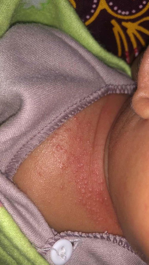 Brutusan di badan bayi 1 bulan