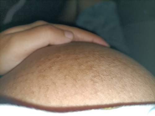 มีตุมเล็กๆ คล้ายผื่น และรูขุมขนกว้างบริเวณนม