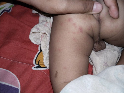 ลูมีตุ่มพองขึ้นตามตัว