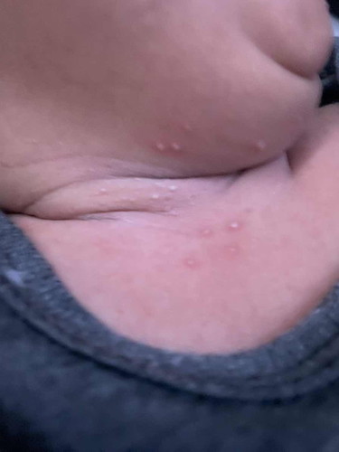 Rekomendasi salep/obat luar