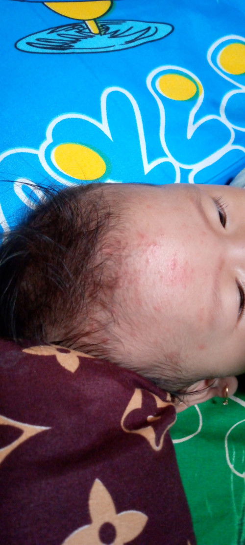 Merah2 pada bayi