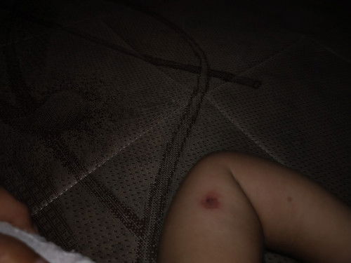 Bentol2 berair pada bayi 1 th