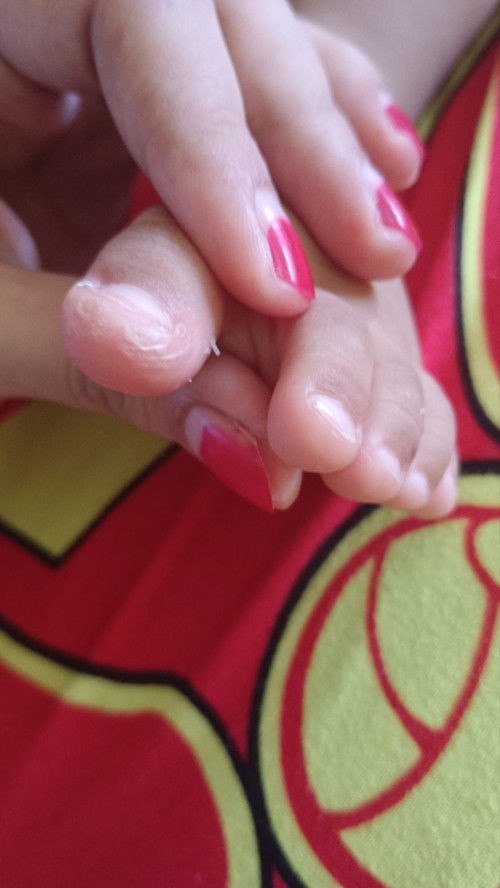 Kulit mengelupas pada anak