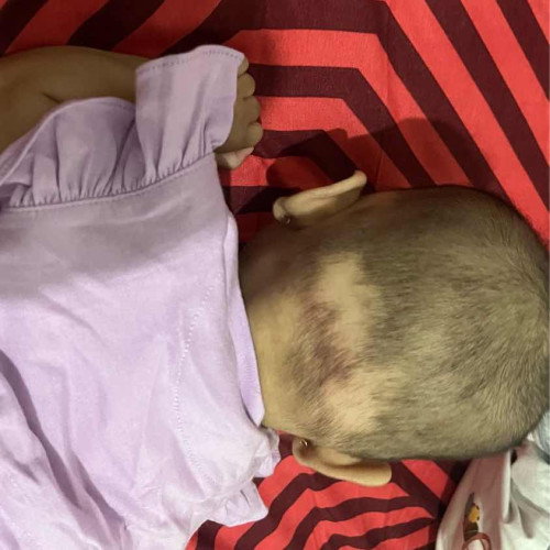 Rambut bayi 3 bulan rontok
