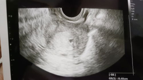 Usg dan hpht beda 3 Minggu