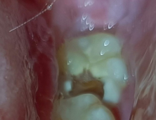 Tooth Extraction