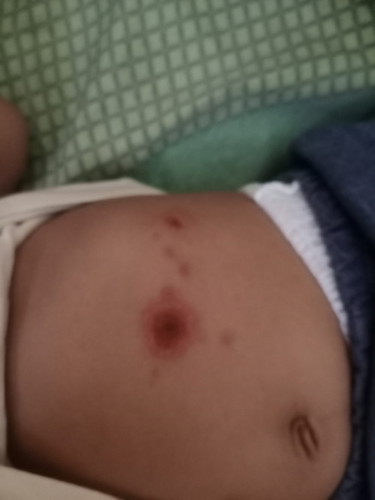 Bund , adakah anak bunda yg ngalami kayak gini? Di kasih obat apa ya? Tiba2 muncul kayak luka kecil