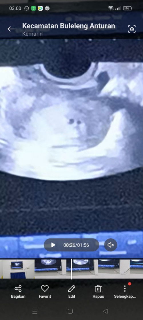 Salah liat apa memang ada 2 kantong janin