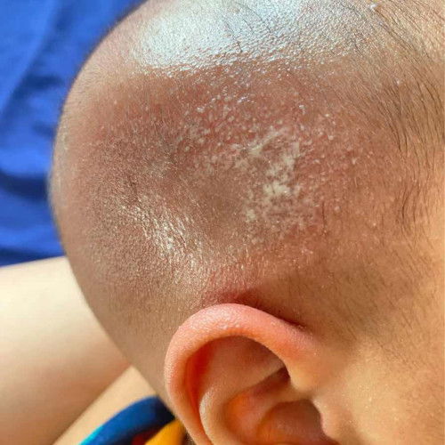 Kemerahan hingga bernanah