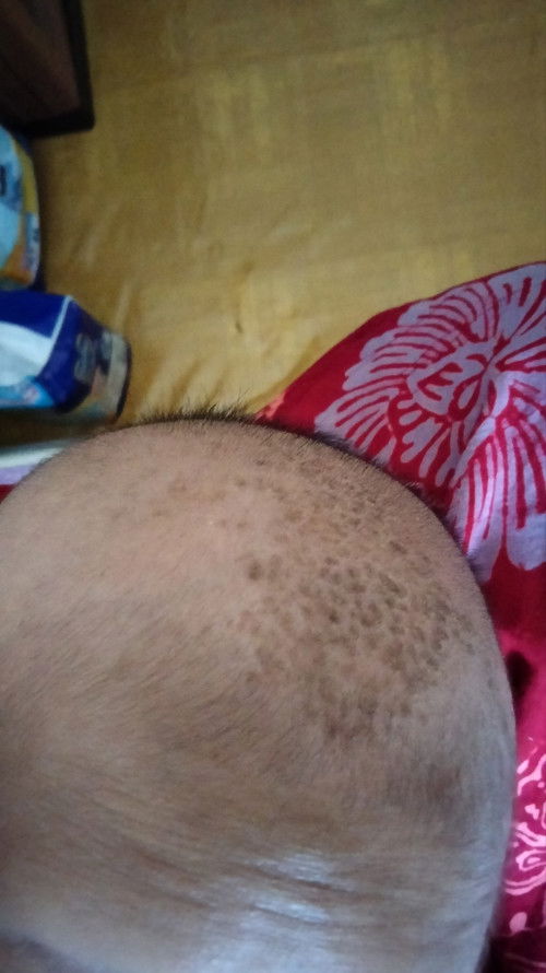 Cara ilangin kerak di kepala