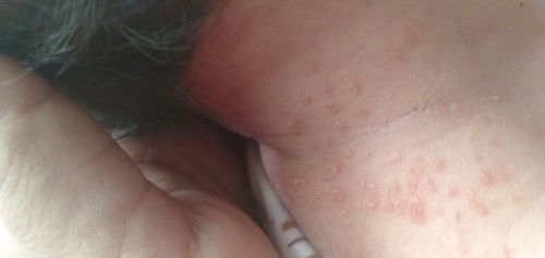 Bruntusan di lipatan badan bayi