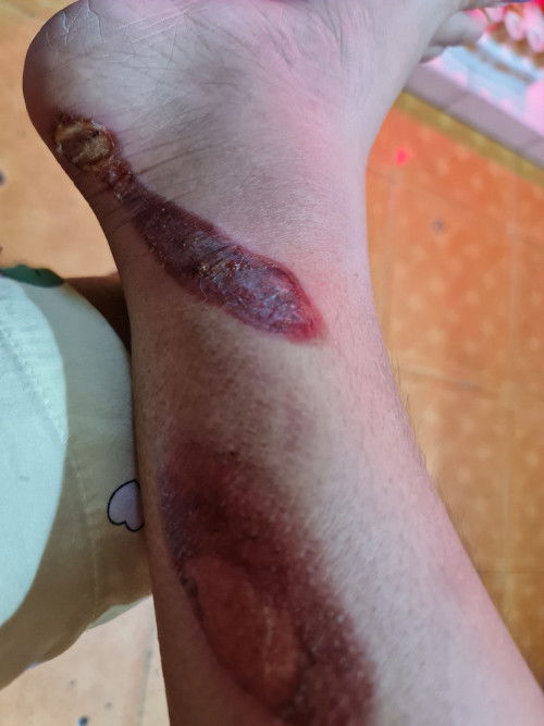 Chân phỏng bô mưng mủ