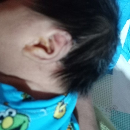 Yellow fluid sa tinga ni baby