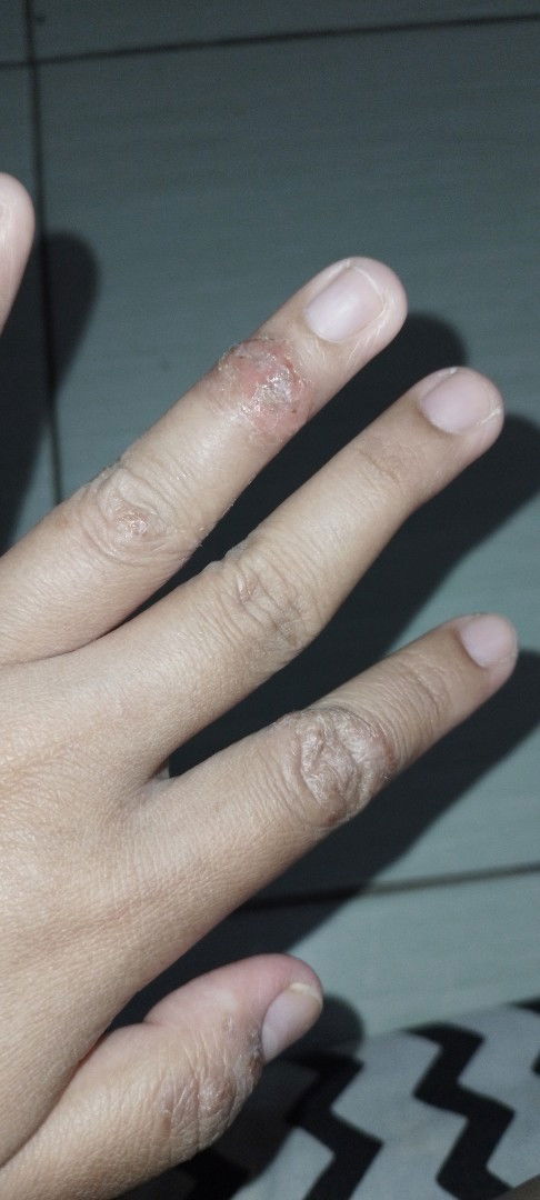 Luka gatal² di tangan