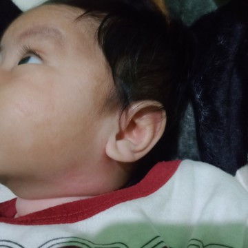 Bercak putih pada bayi