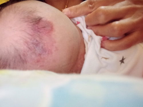 Tanda lahir di kepala berair