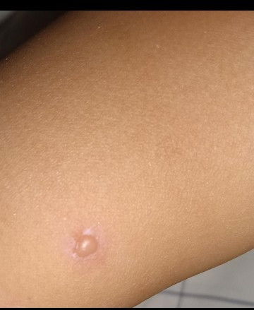 Lentingan berair di tangan dan wajah bayi