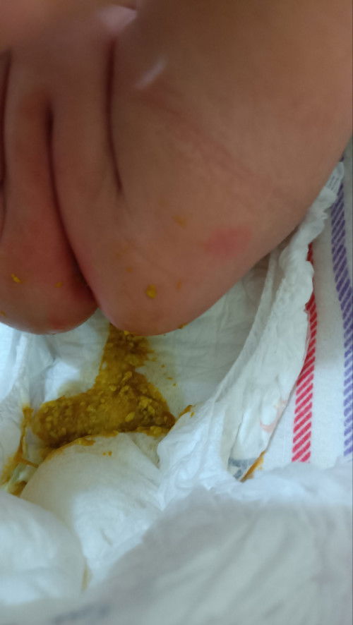 Maaf gambar 💩  bayi 2bulanan normal gak, bu? Sudah 💩 5x tapi sedikit2, biasanya 💩banyak 2-3x/hari