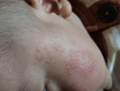 BUN INI KENAPA Y PIPI ANAK KU KIRI KANAN MERAH KAYA GINI? DAN PAKAI APA YAH?