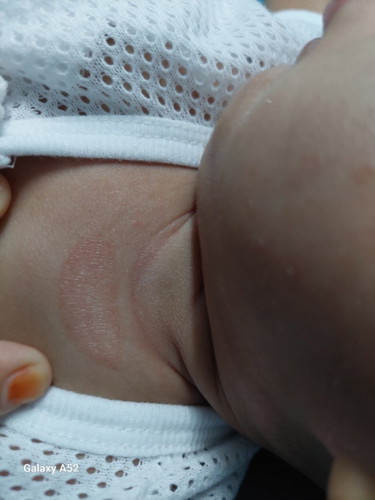 Lingkaran merah pada kulit bayi