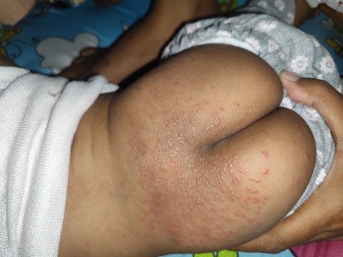 Bintik bintik merah area pantat spai punggung