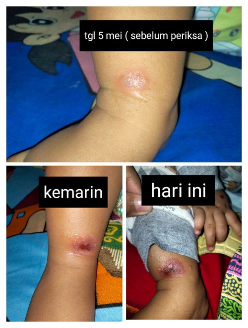 kaki baby 8bln muncul seperti itu sudah periksa tgl 6 tpi kok mlh luka.ny mkin lebar klihatan melpuh