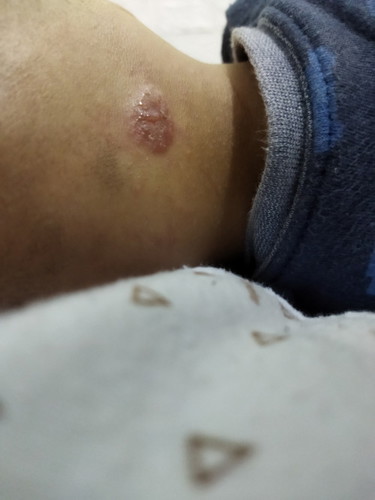 Bun aku galau nih anakku jd bernanah salepnya apa ya tiap digendong kegesek trs jd berair