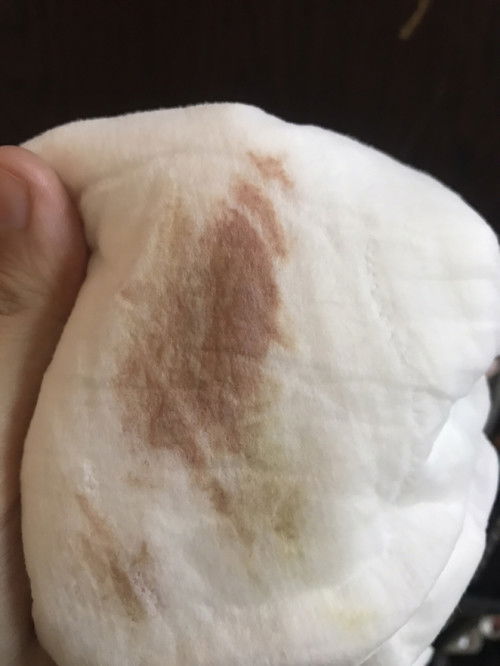 ตกขาวมีสีคล้ายเลือดแต่ไม่มีอาการอะไรเลย