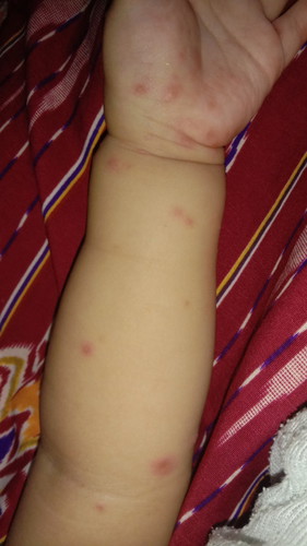 Cara pengobatan flu singapur gimana ya bun๐