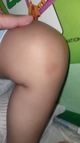 Pasa po ba ito o Insect bite?