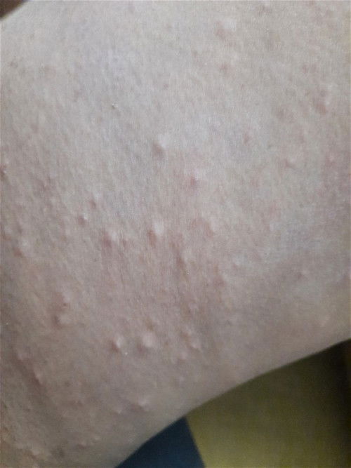 Gatal gatal bumil usia 36week