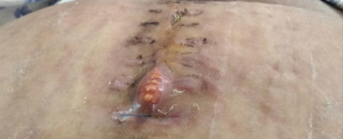 ตัดไหมช้าจะเป็นไรมั้ยคะ ไหมจมเนื้อไปแล้ว