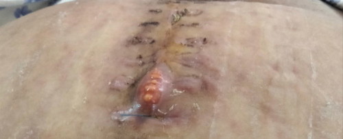 ตัดไหมช้าจะเป็นไรมั้ยคะ ไหมจมเนื้อไปแล้ว