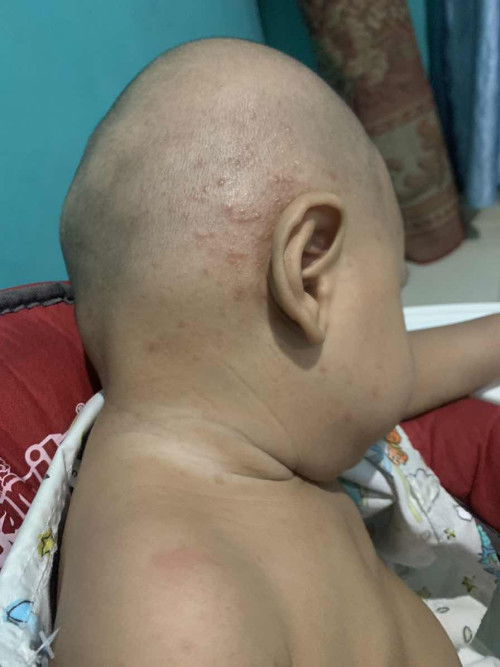 Gatal sekitar 2 mingguan