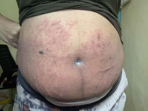 Gatal” diseluruh badan setelah Lahiran SC