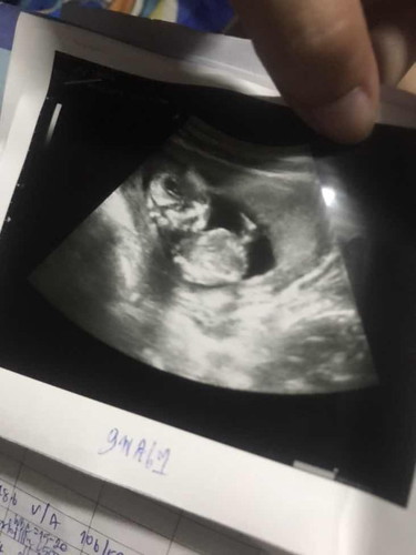 ท้องแรก 14 สัปดาห์ ป้าหมอบอกน้องตัวใหญ่มาก💖👶🏻🫶🏻