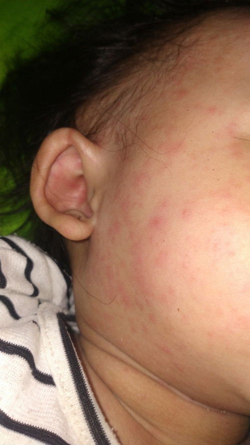 Bu maaf mau tanya, ini si Dede biang keringet/campak yaa mohon info🙏 bagaimana cara mengobatinya.