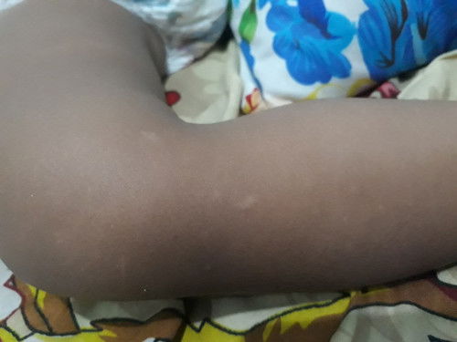 Bercak putih di badan bayi