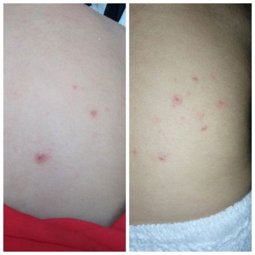 Gatal biasa atau cacar?