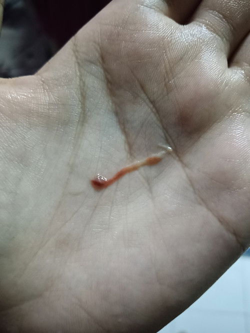 Assalamuaikum Nak Tanya Saya skrng Baru 33week , smlm kencing keluar darah macam ni , normal ke ?