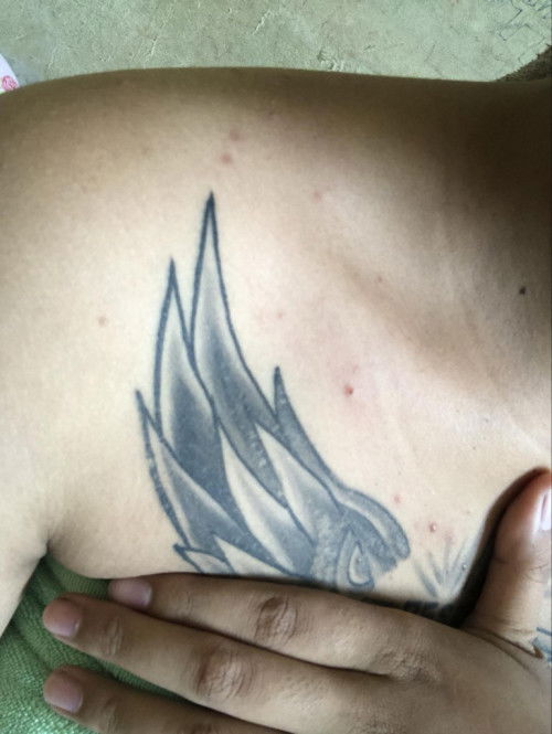 ตุ่มแบบนี้จะทำยังไงไห้หายไปคะแม่ๆ