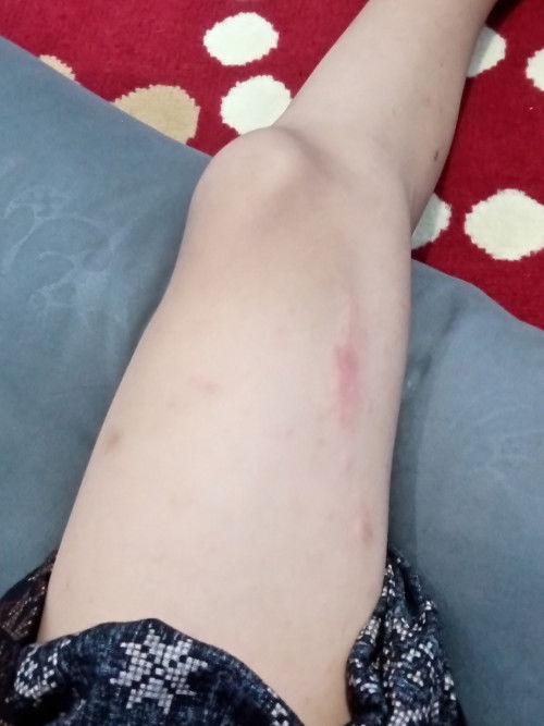 Gatal gatal di kaki dan gakbisa sikat gigi karena sehabis sikat gigi mual