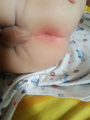 ลูกตูดแดงเกิดจาก