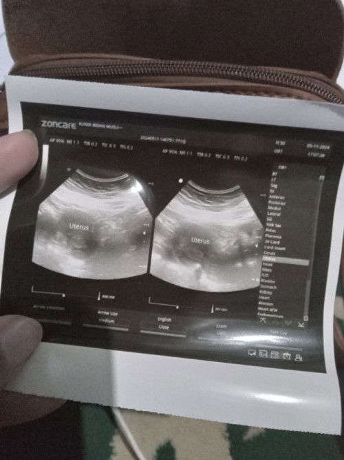 Kabar setelah pendarahan