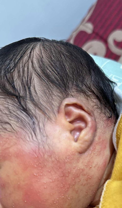 Bintik putih pada bayi