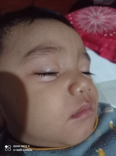 Bun baby 10 buln mkn ikan tongkol, gk lama ko mata bngkak muka gatel ap itu alergi obat ny ap si bun