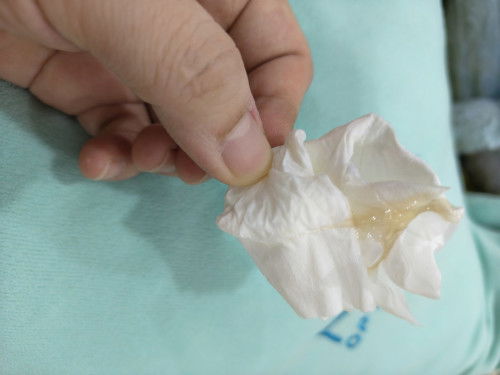 E trễ kinh 2,3 day .mà ra huyết nv có phải máu báo thai k ạh .các mom có kn chia xẻ cho e với.tks nạ